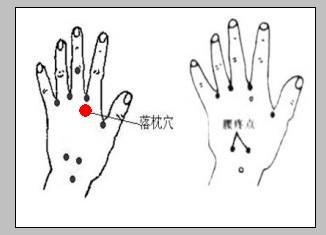 用落枕穴治疗落枕（悬钟穴、后溪穴、束骨穴、承山穴）