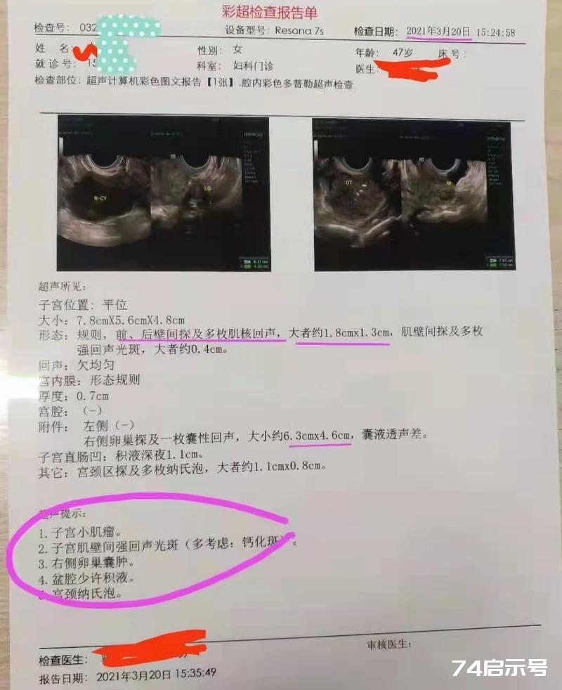 周炳昆用经方治子宫肌瘤案