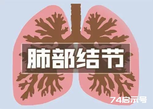 20多年前，师父跟我说：对付肺结节，就是要将树连根拔起，而不是摘果子！要不然只会是白费功夫！