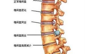 腰椎间盘突出症中医如何辩证施治？3、 腰椎间盘突出症一定要做手术吗？