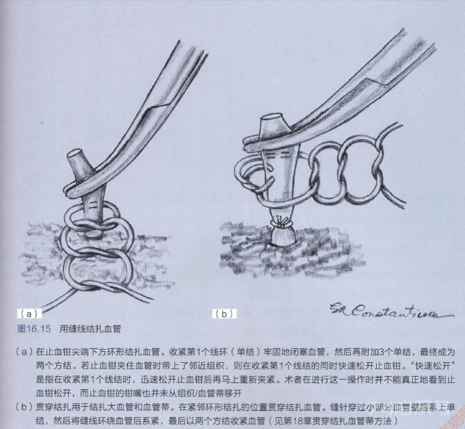 【今日读书】看完这篇，外科止血方法你就基本见全了