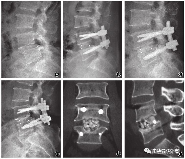 【临床论著】经椎间孔单节段腰椎椎间融合术后融合器下沉的危险因素分析