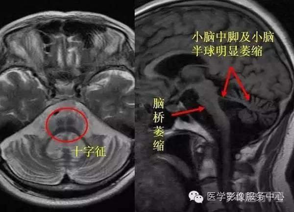 橄榄脑桥小脑萎缩的诊断要点（十字征）