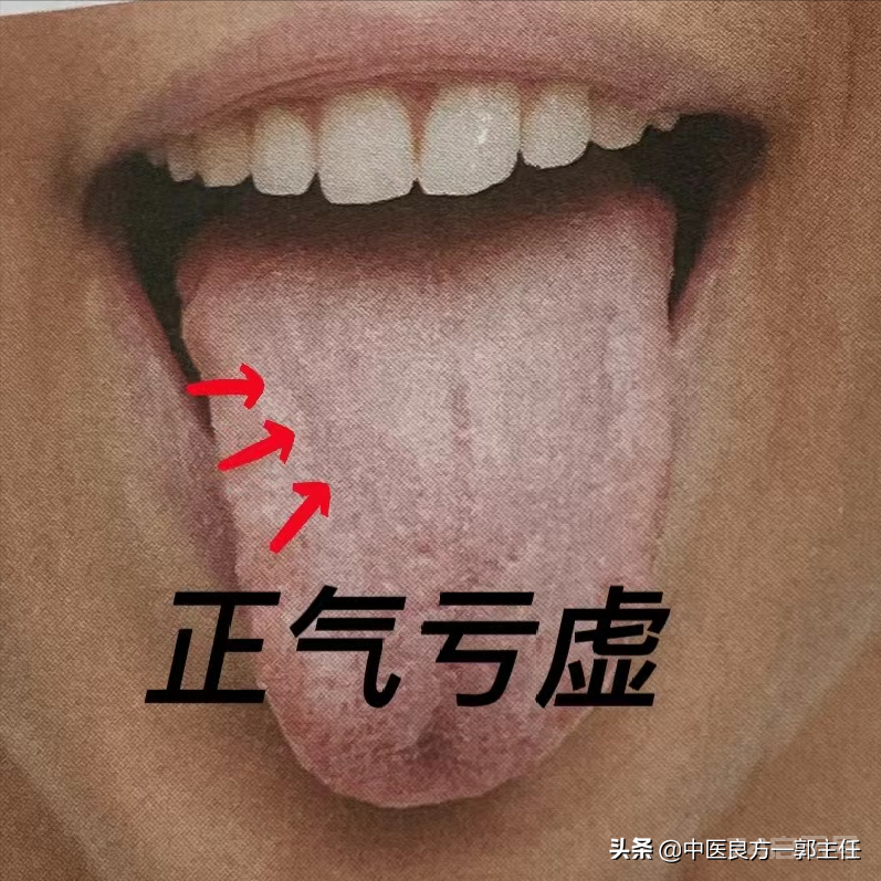 气虚体质的人7种舌象各不一样，看看你是哪一种？