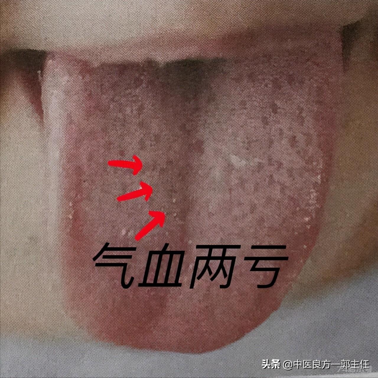 气虚体质的人7种舌象各不一样，看看你是哪一种？