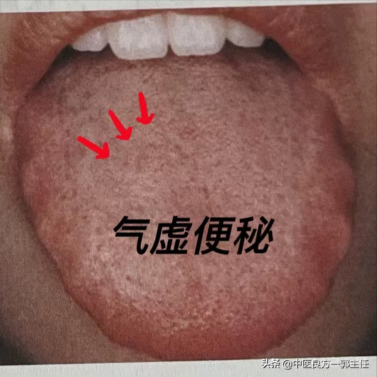 气虚体质的人7种舌象各不一样，看看你是哪一种？