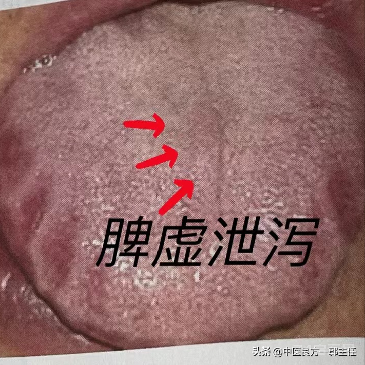 气虚体质的人7种舌象各不一样，看看你是哪一种？