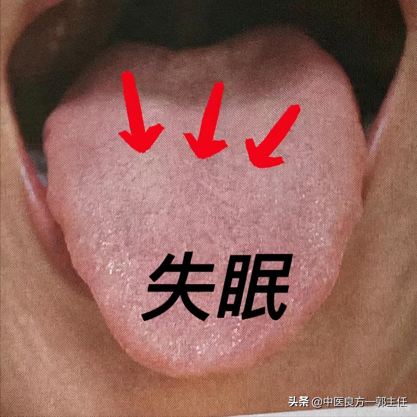 气虚体质的人7种舌象各不一样，看看你是哪一种？