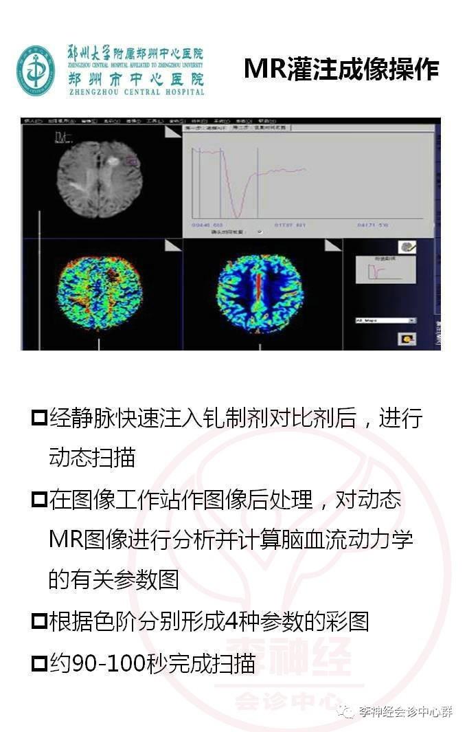 PPT 注释 | 脑灌注成像（DSC）的临床应用（1）--李润涛