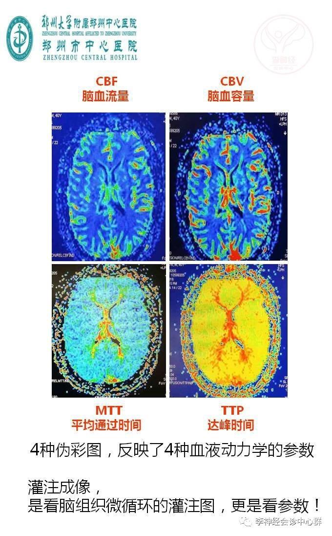PPT 注释 | 脑灌注成像（DSC）的临床应用（1）--李润涛