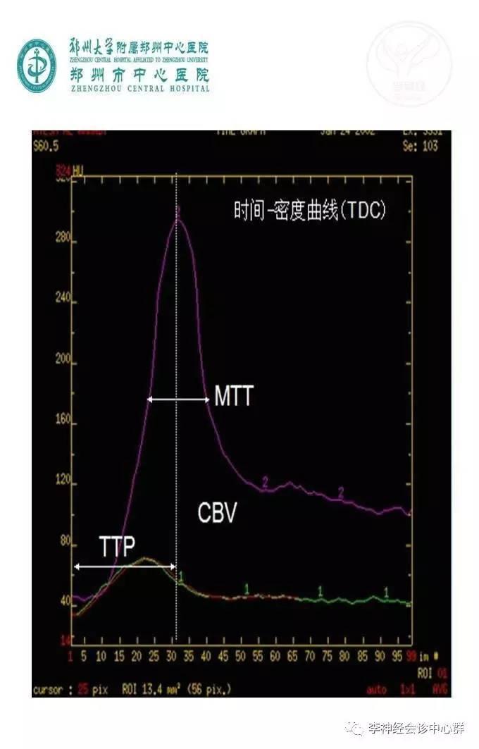 PPT 注释 | 脑灌注成像（DSC）的临床应用（1）--李润涛