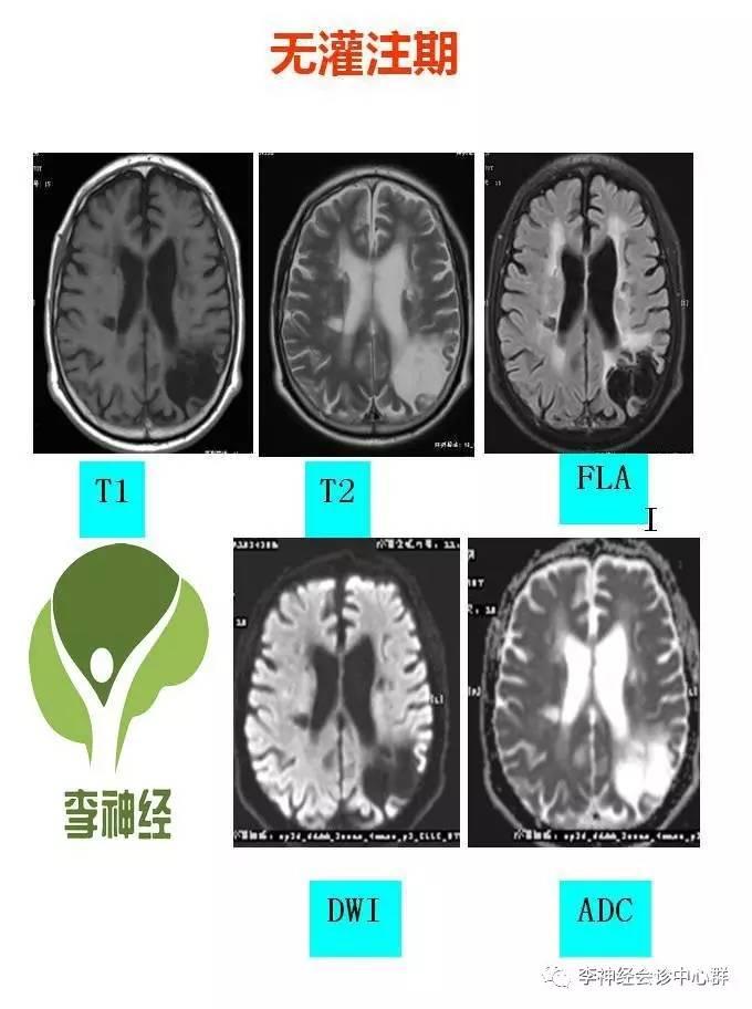 PPT 注释 | 脑灌注成像（DSC）的临床应用（1）--李润涛