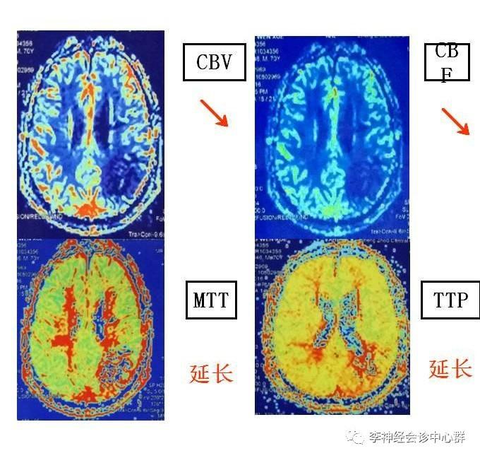 PPT 注释 | 脑灌注成像（DSC）的临床应用（1）--李润涛