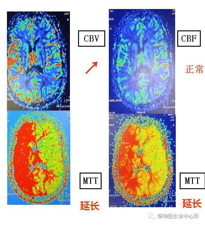 PPT 注释 | 脑灌注成像（DSC）的临床应用（1）--李润涛