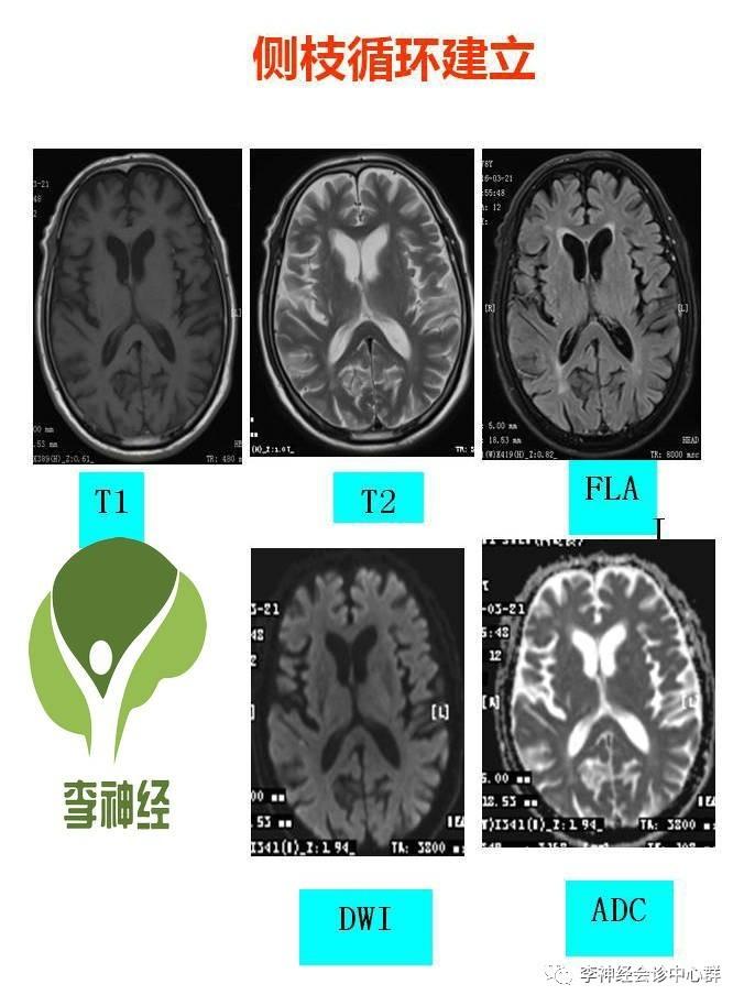 PPT 注释 | 脑灌注成像（DSC）的临床应用（1）--李润涛