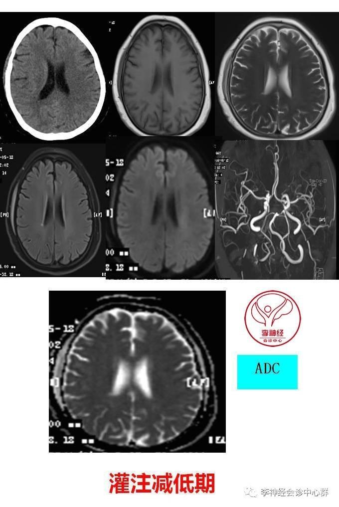 PPT 注释 | 脑灌注成像（DSC）的临床应用（1）--李润涛