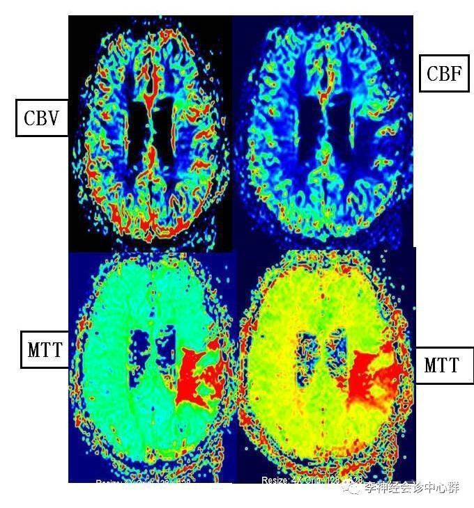 PPT 注释 | 脑灌注成像（DSC）的临床应用（1）--李润涛