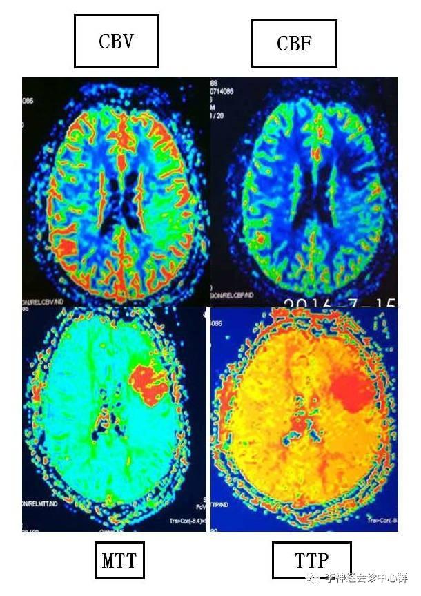 PPT 注释 | 脑灌注成像（DSC）的临床应用（1）--李润涛