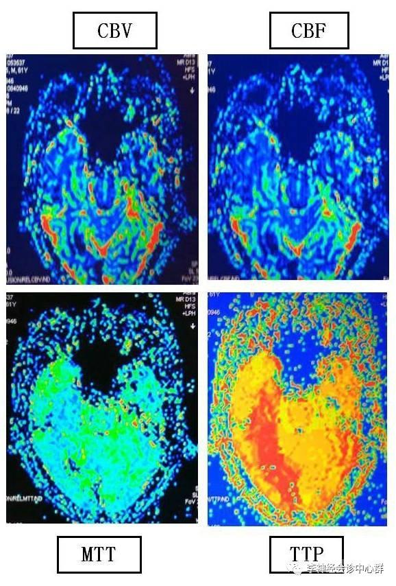 PPT 注释 | 脑灌注成像（DSC）的临床应用（1）--李润涛