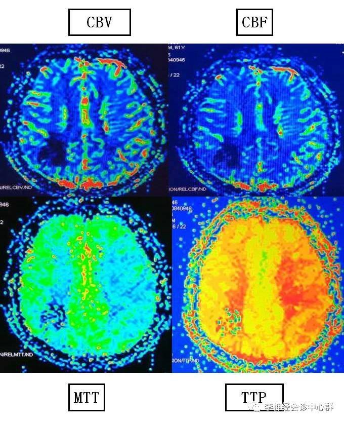 PPT 注释 | 脑灌注成像（DSC）的临床应用（1）--李润涛