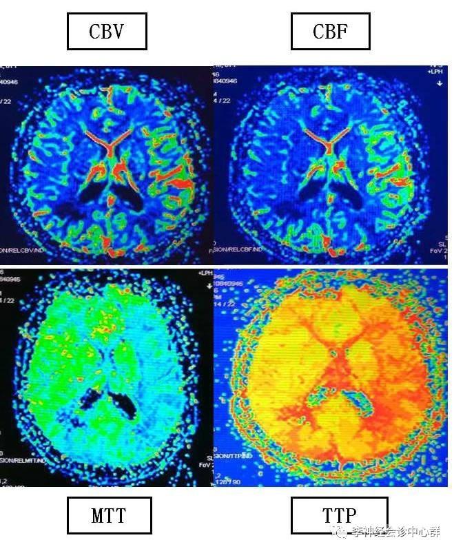 PPT 注释 | 脑灌注成像（DSC）的临床应用（1）--李润涛