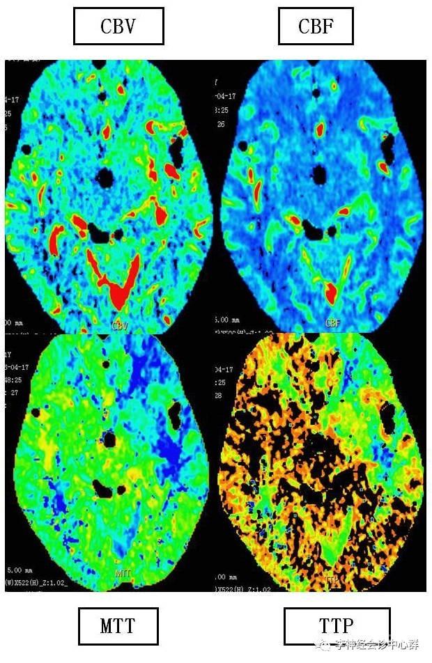PPT 注释 | 脑灌注成像（DSC）的临床应用（1）--李润涛
