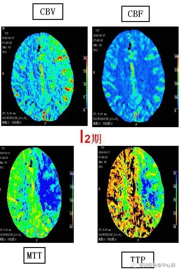 PPT 注释 | 脑灌注成像（DSC）的临床应用（1）--李润涛