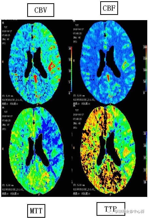 PPT 注释 | 脑灌注成像（DSC）的临床应用（1）--李润涛