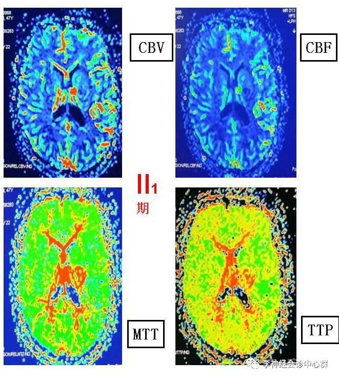 PPT 注释 | 脑灌注成像（DSC）的临床应用（1）--李润涛