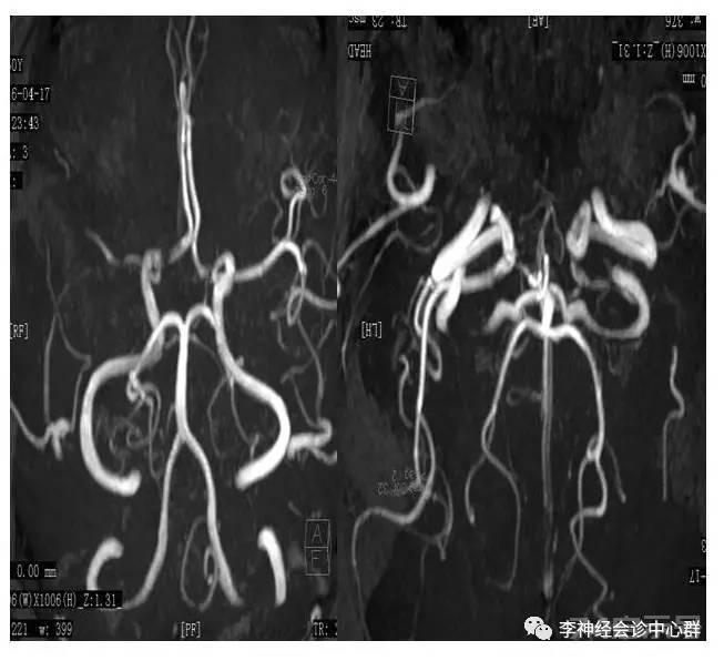 PPT 注释 | 脑灌注成像（DSC）的临床应用（1）--李润涛