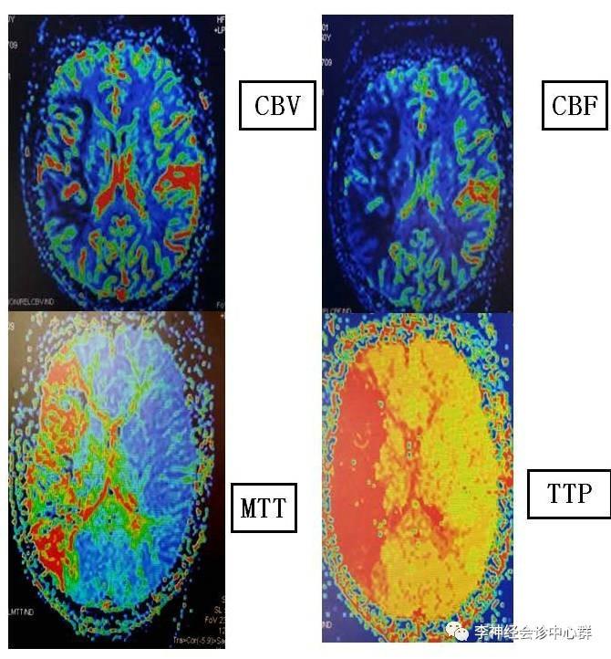 PPT 注释 | 脑灌注成像（DSC）的临床应用（1）--李润涛