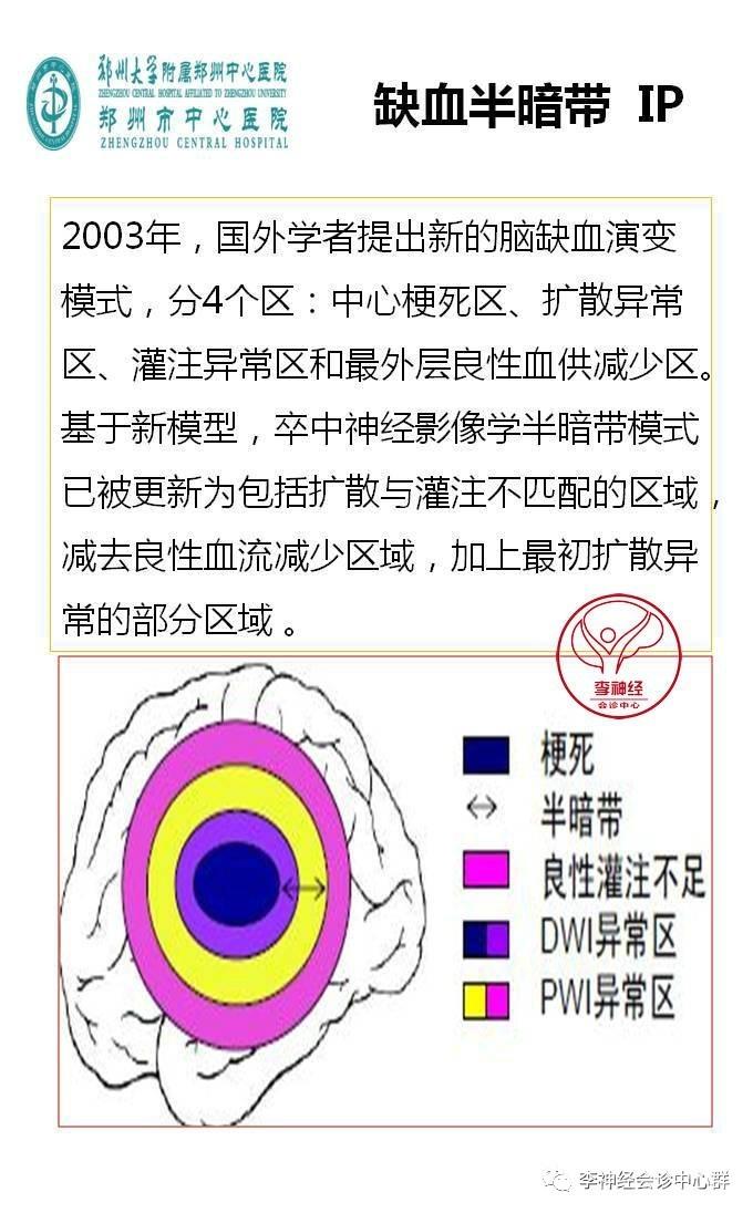 PPT 注释 | 脑灌注成像（DSC）的临床应用（1）--李润涛