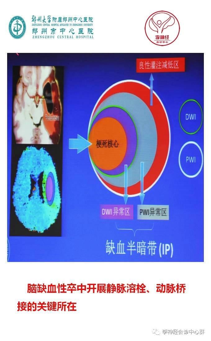 PPT 注释 | 脑灌注成像（DSC）的临床应用（1）--李润涛