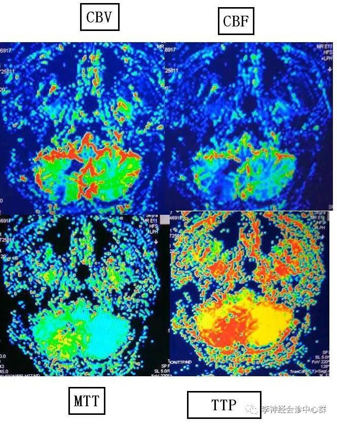 PPT 注释 | 脑灌注成像（DSC）的临床应用（1）--李润涛