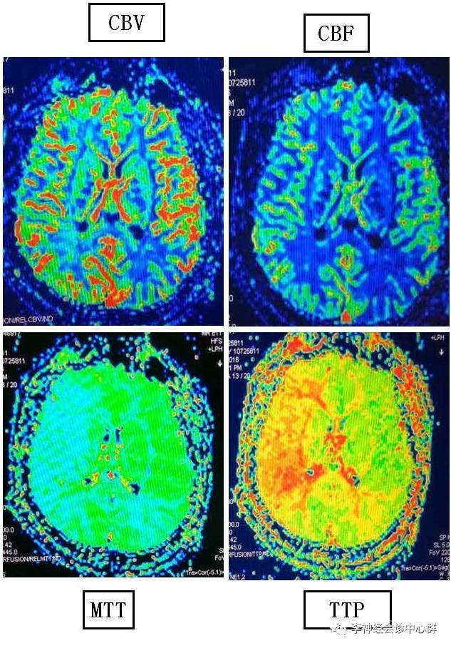 PPT 注释 | 脑灌注成像（DSC）的临床应用（1）--李润涛