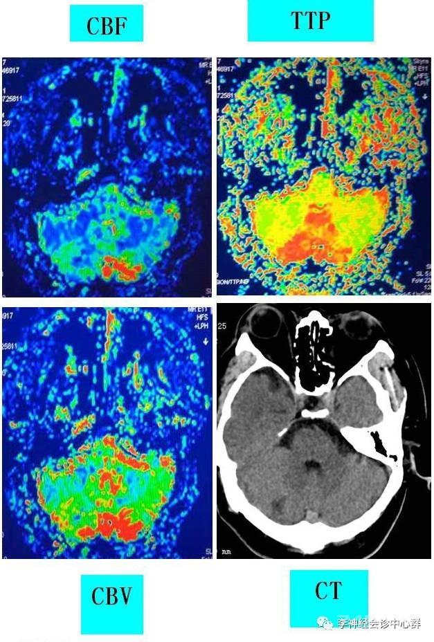 PPT 注释 | 脑灌注成像（DSC）的临床应用（1）--李润涛