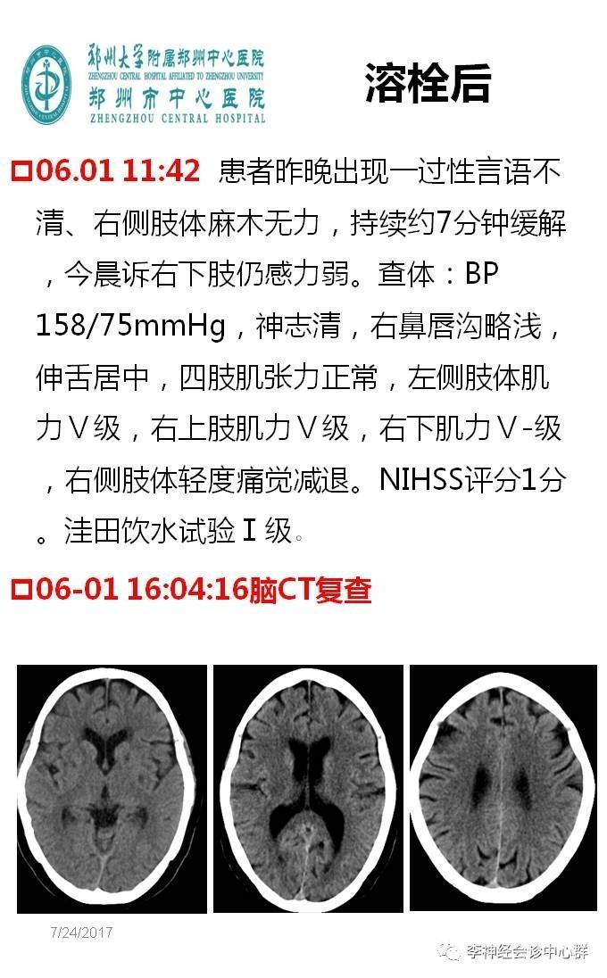 PPT 注释 | 脑灌注成像（DSC）的临床应用（1）--李润涛