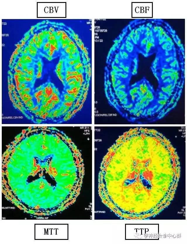 PPT 注释 | 脑灌注成像（DSC）的临床应用（1）--李润涛