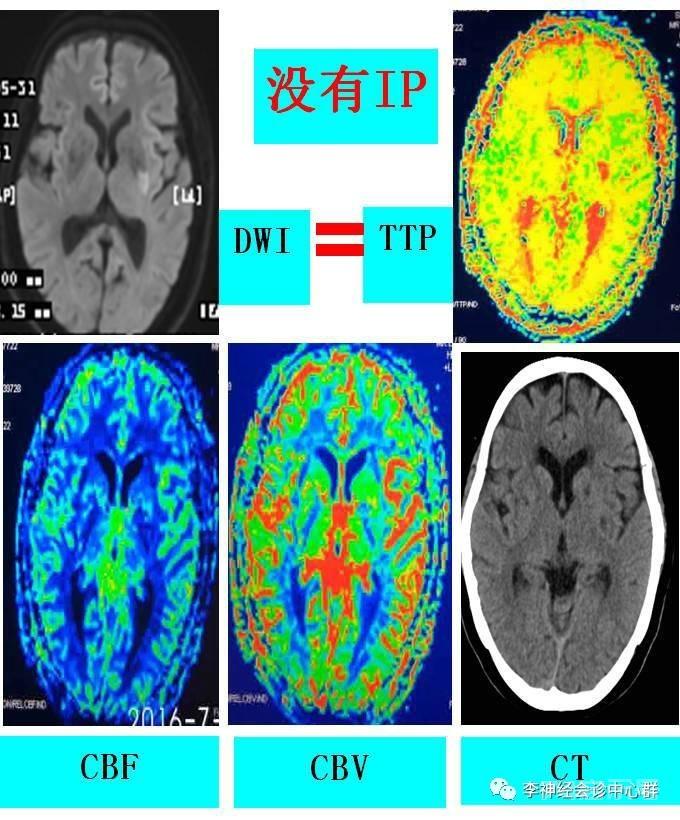 PPT 注释 | 脑灌注成像（DSC）的临床应用（1）--李润涛