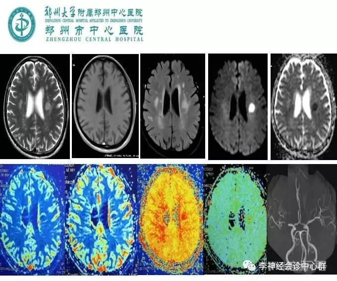 PPT 注释 | 脑灌注成像（DSC）的临床应用（1）--李润涛