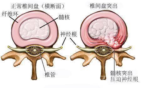 赶走腰椎间盘突出有妙方，只此1招让你轻松告别病痛，快存！