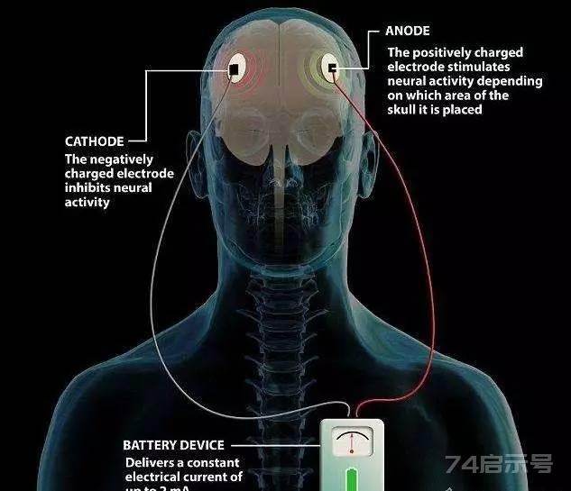 【科普】神经电刺激那些事儿