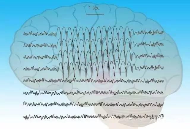 【科普】神经电刺激那些事儿