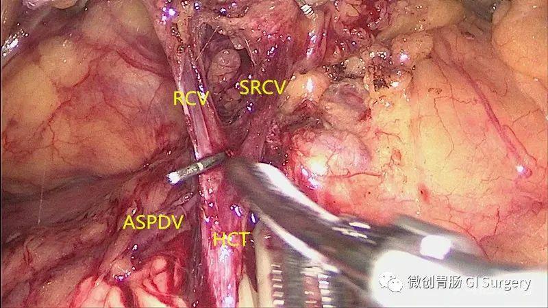 图解腹腔镜右半结肠 Henle 干解剖