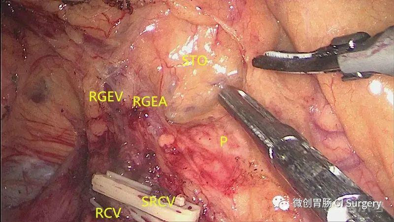 图解腹腔镜右半结肠 Henle 干解剖