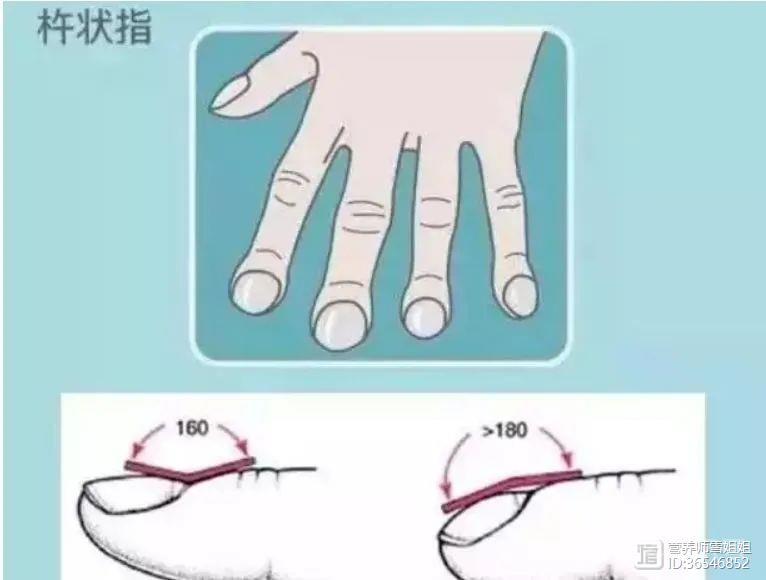 吸烟者，出现“1大、2痛”，小心肺癌，及时查CT，切莫拖延