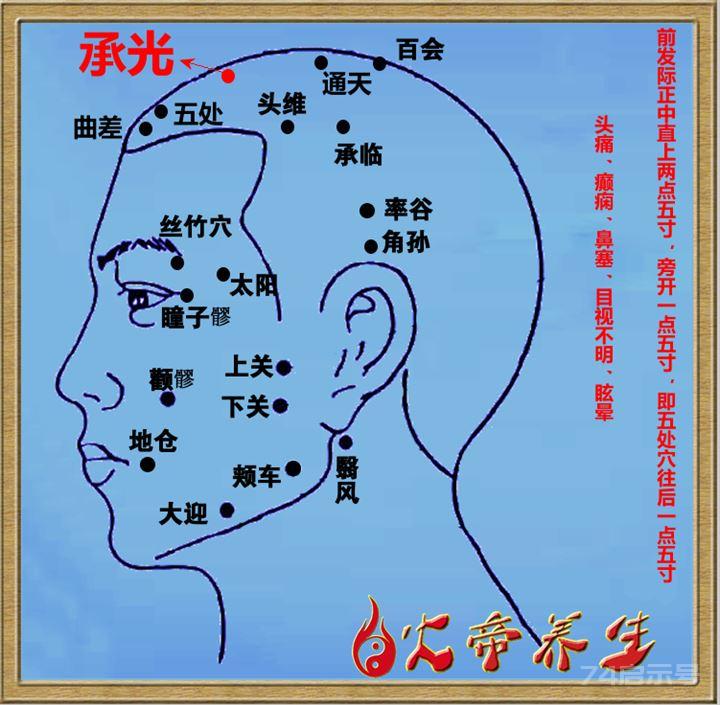 倪海厦针灸笔记（一五三）——五处穴与承光穴