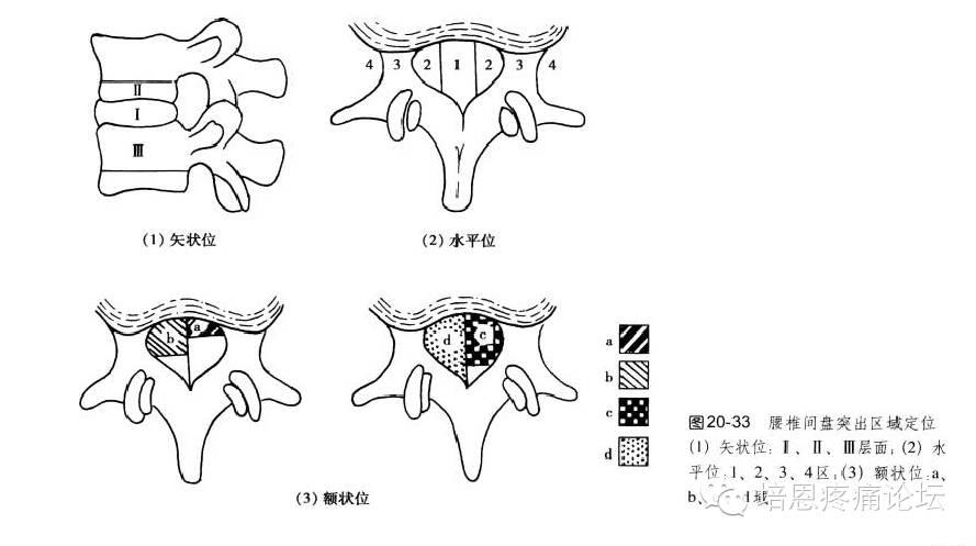 腰椎间盘突出影像学表现与临床症状的关联性