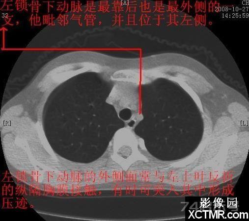 胸部CT断层解剖纵隔血管气管分支标注详解