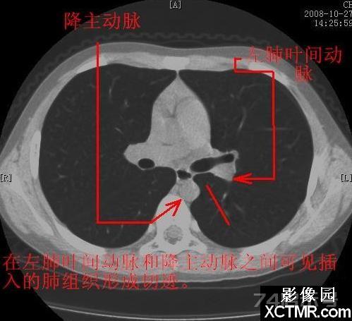 胸部CT断层解剖纵隔血管气管分支标注详解